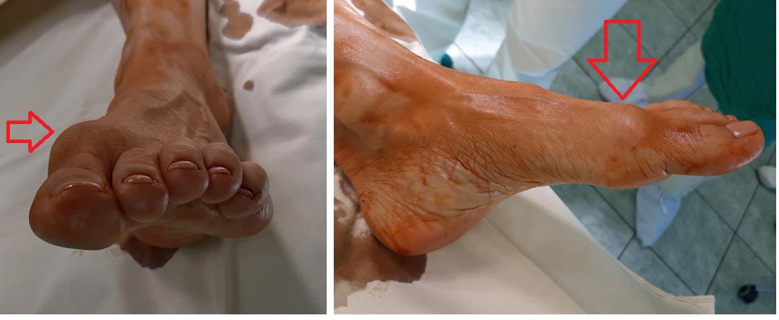 Лечение дистрофии ногтя: причины, симптомы и диагностика заболевания в EMC
